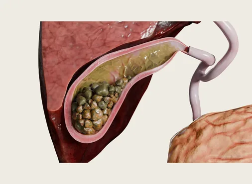 Gallbladder & Biliary Disorders